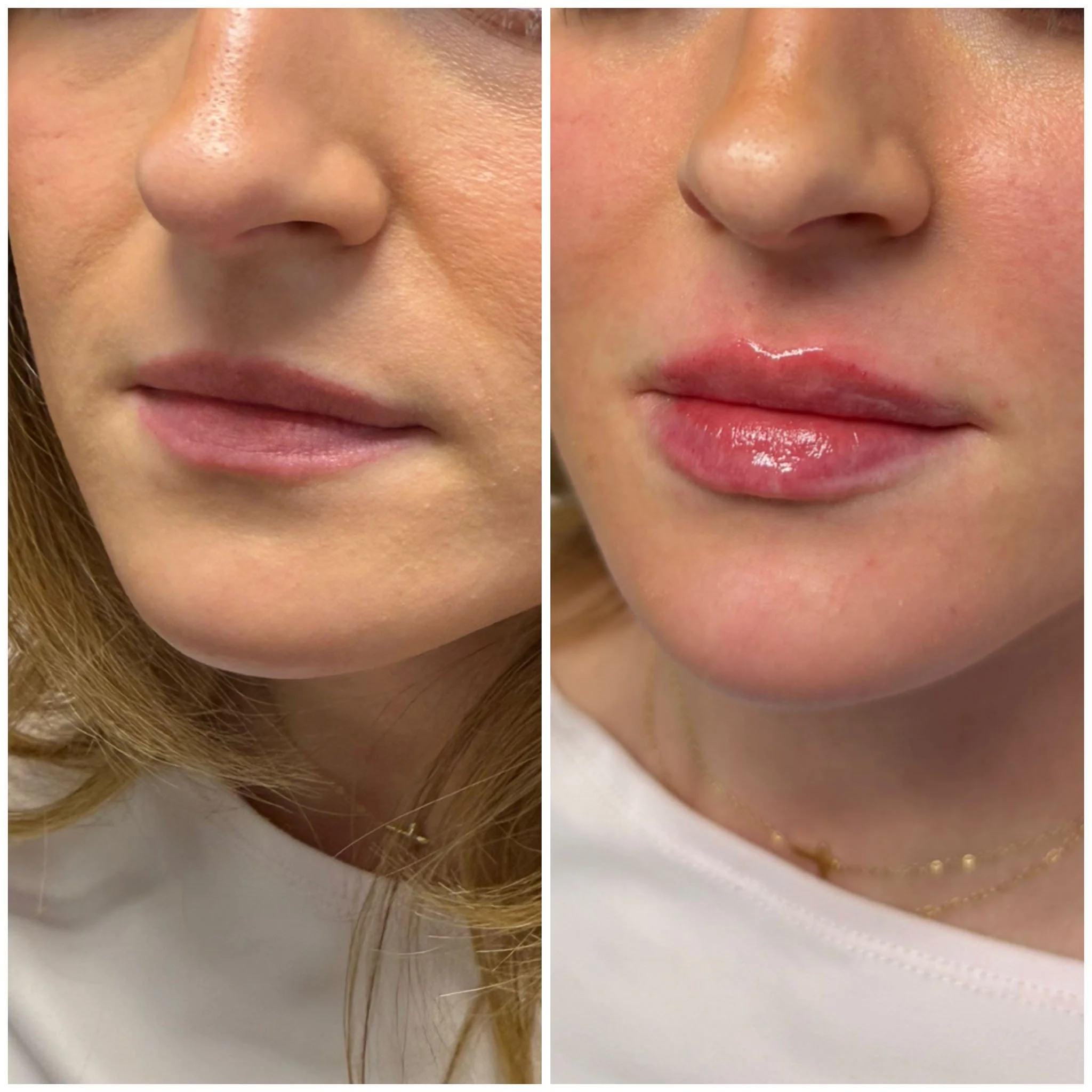 lip-filler-before-after.jpg