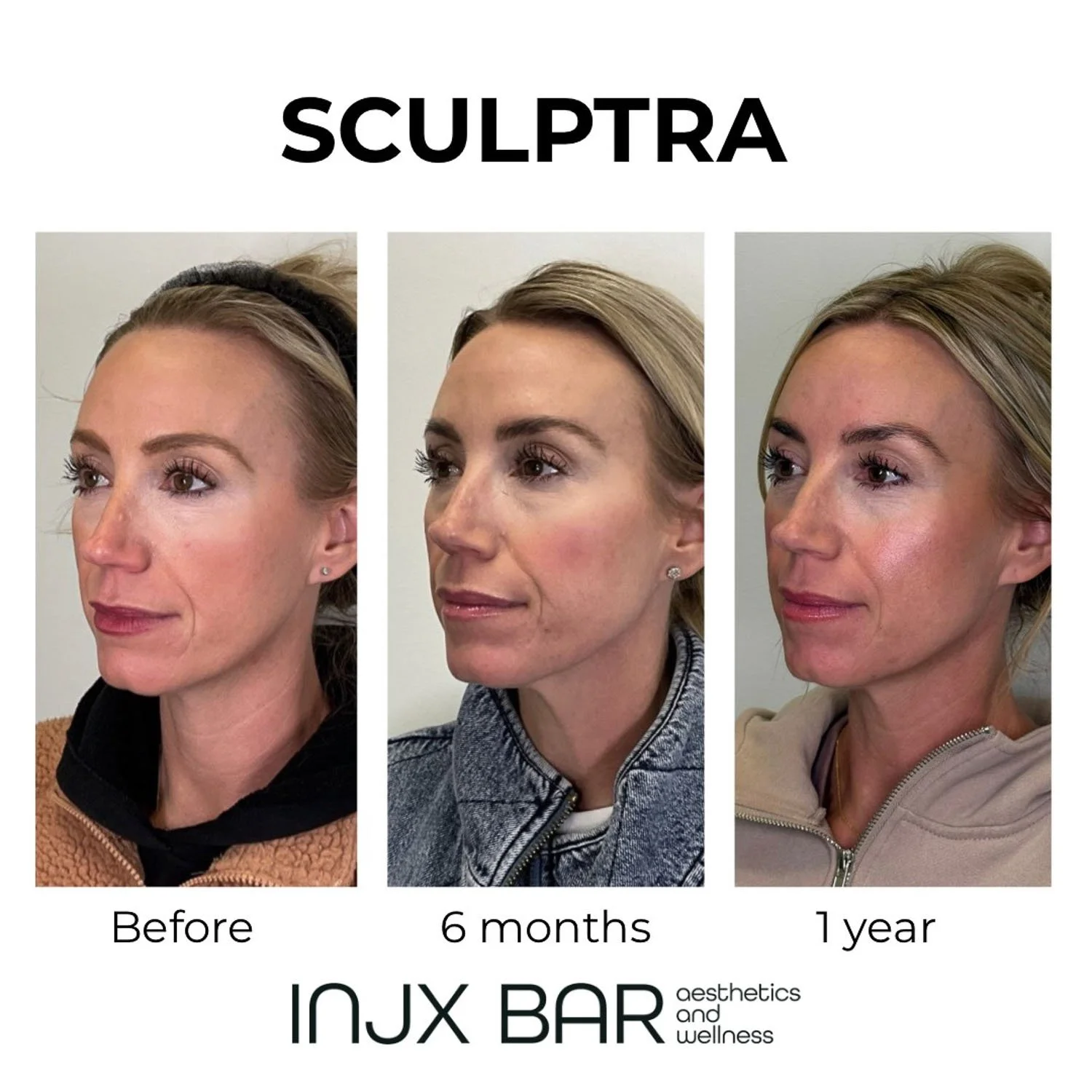 sculptra-injections-near-me.jpg