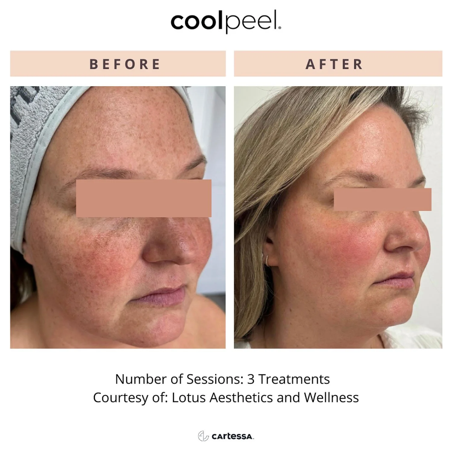 coolpeel-co2-laser-before-after-cheeks.jpg