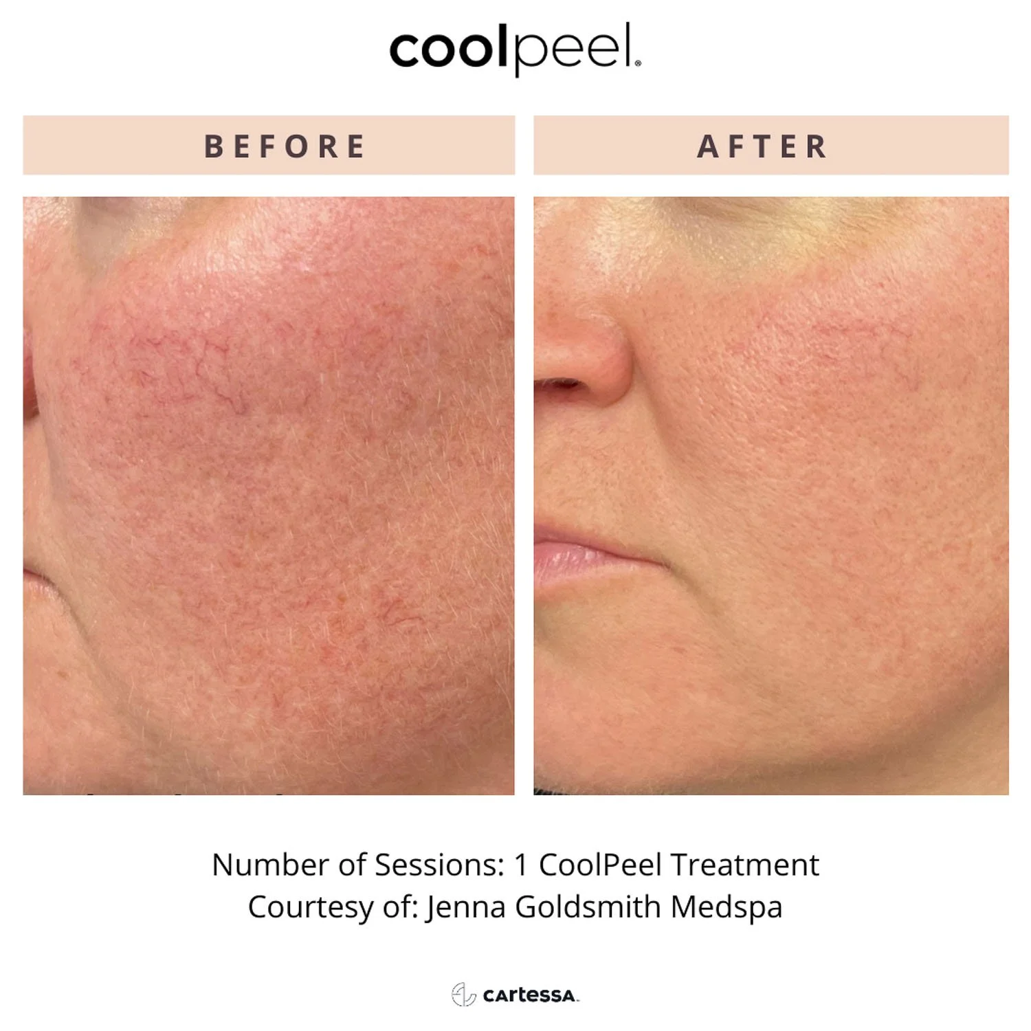 cool-peel-laser-before-after-cheeks.jpg