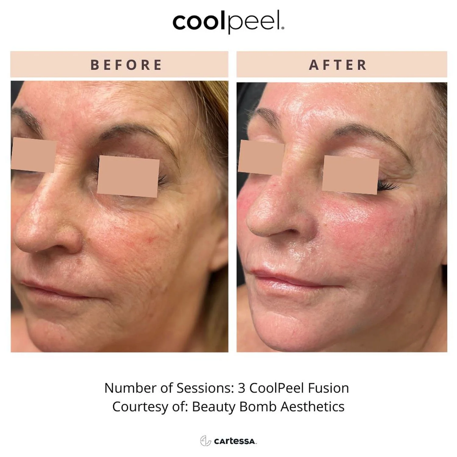 cool-peel-laser-before-after-face.jpg