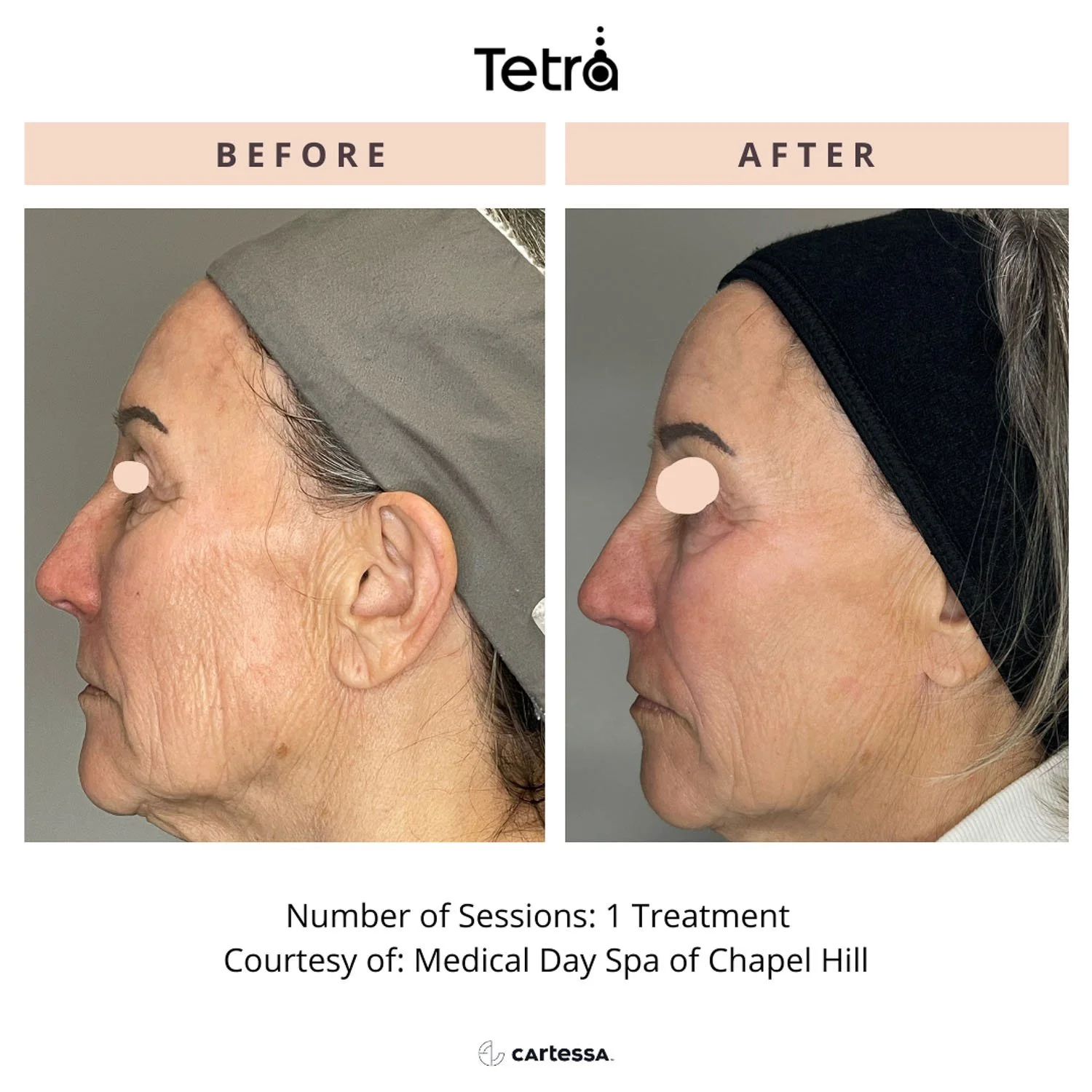 deka-c02-laser-before-after-face.jpg
