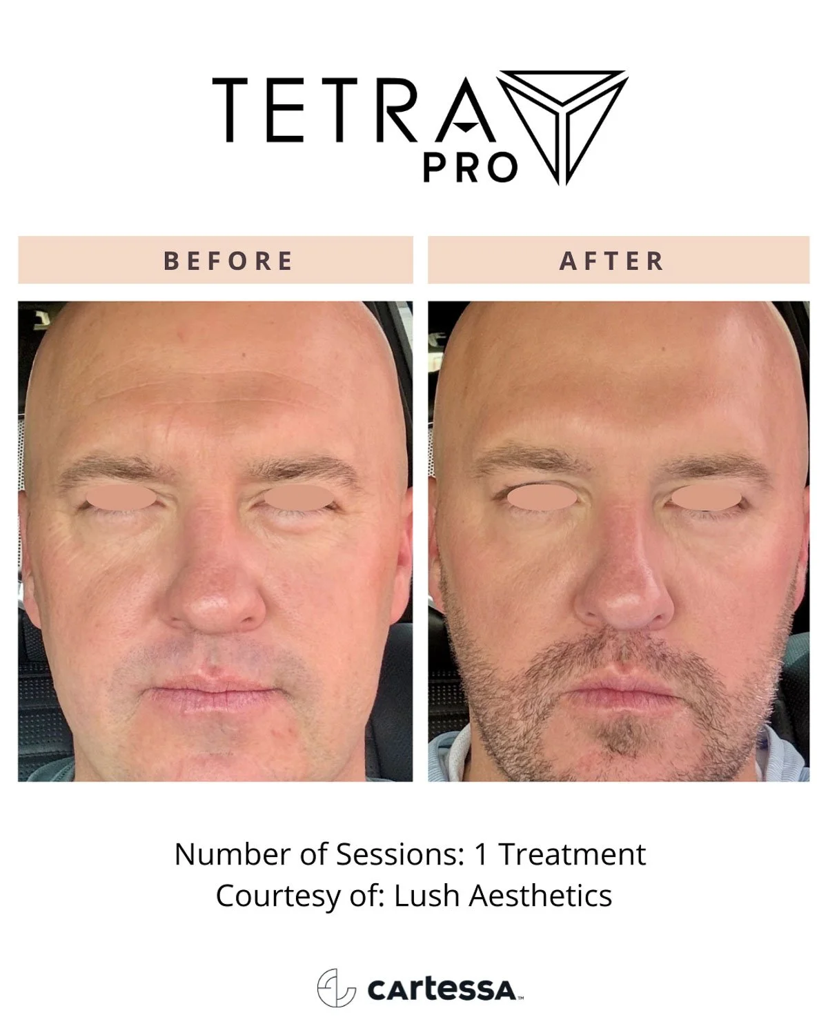 deka-c02-laser-before-after-men.jpg