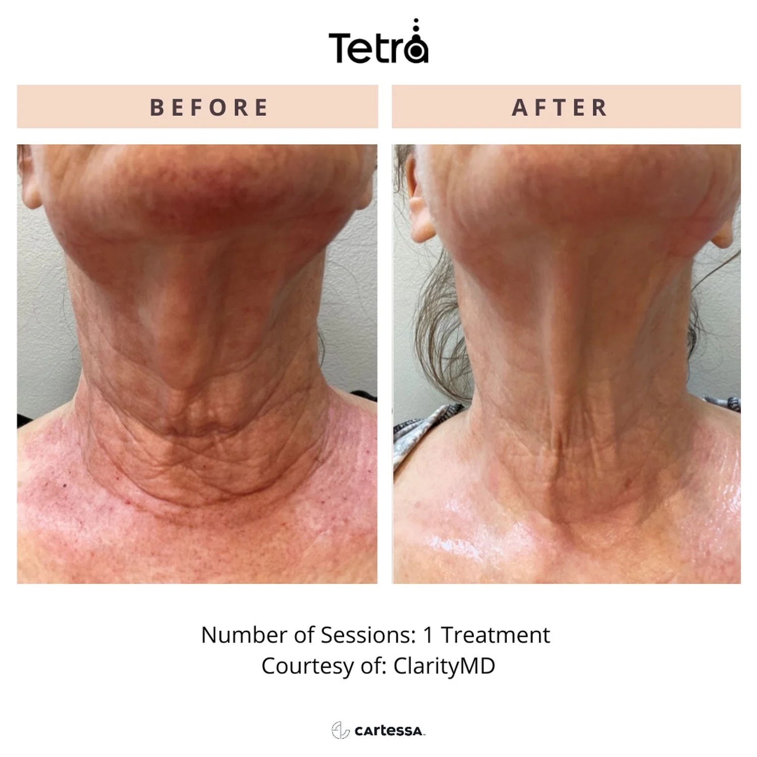 deka-c02-laser-before-after-neck.jpg