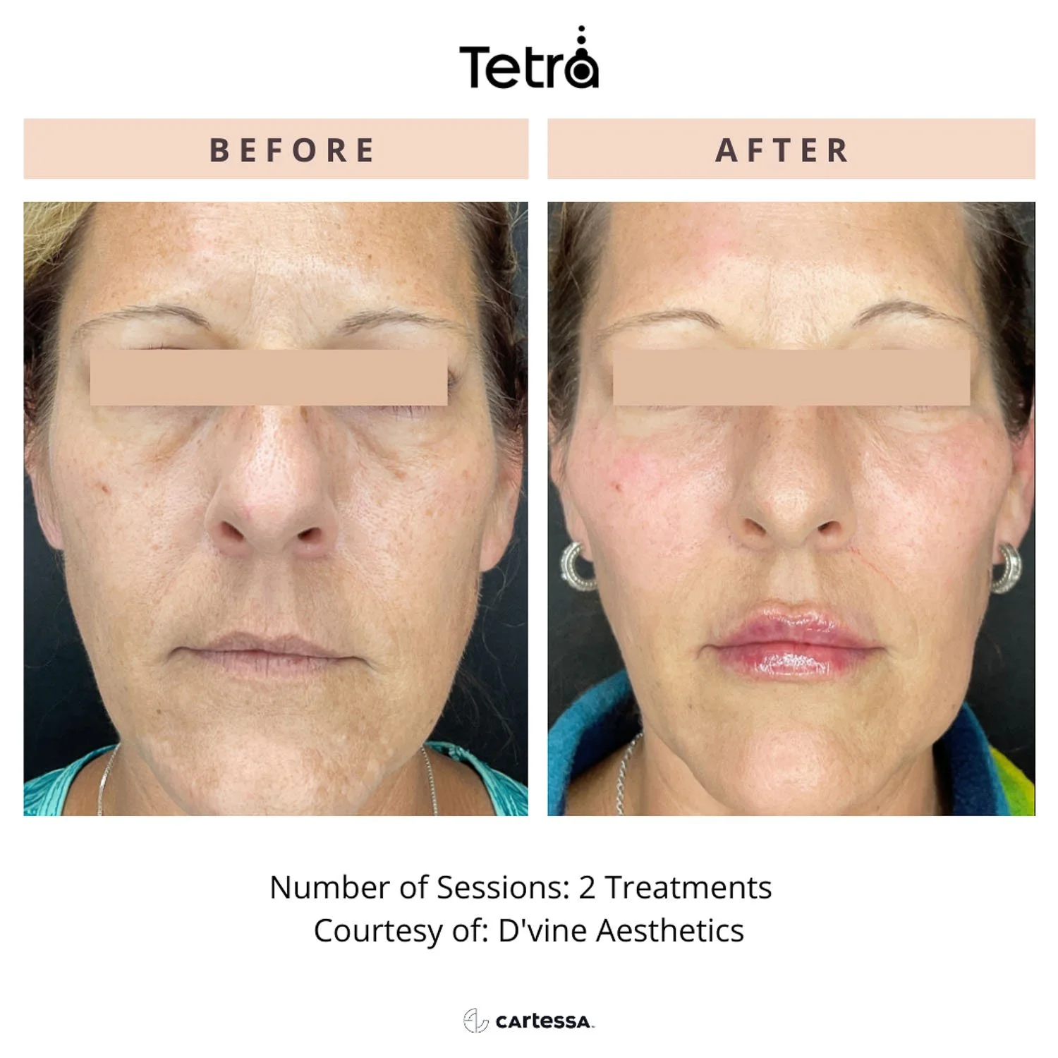 deka-c02-laser-before-after-under-eyes-nearme.jpg