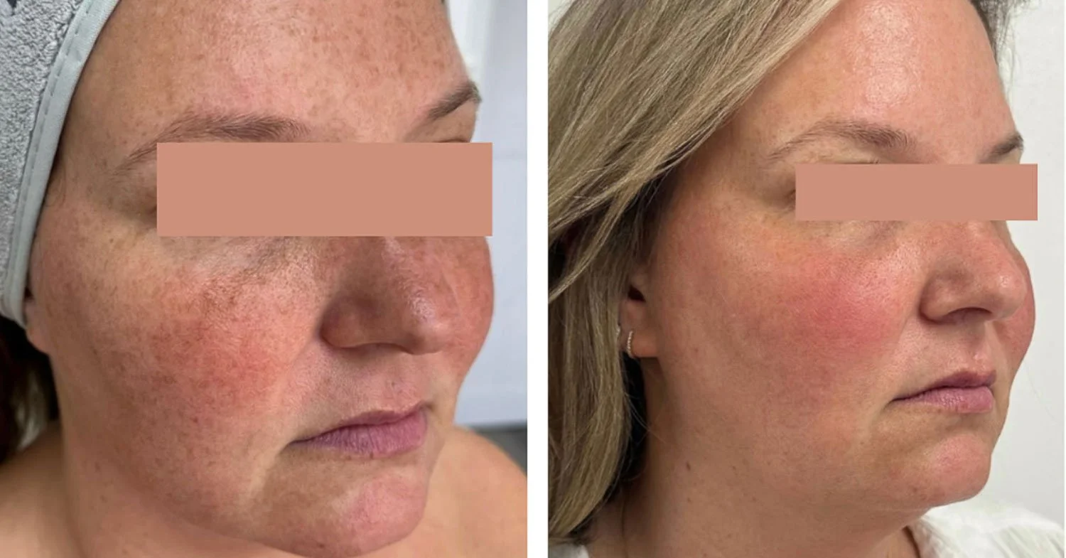 TetraPro Has Entered the Chat: The Modern CO2 Laser That Is Changing The Game