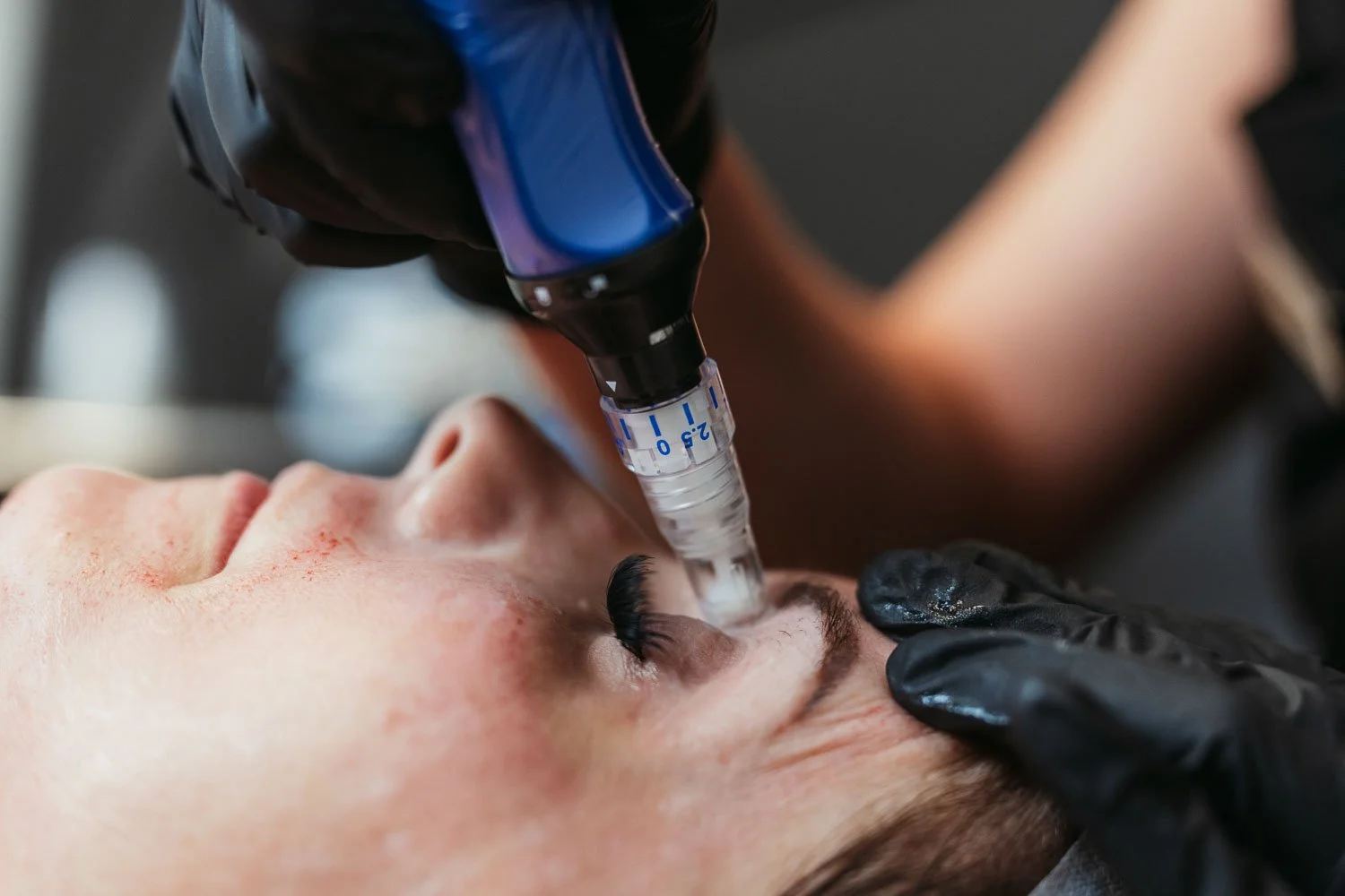 Skinpen microneedling treatments in Peoria, AZ.