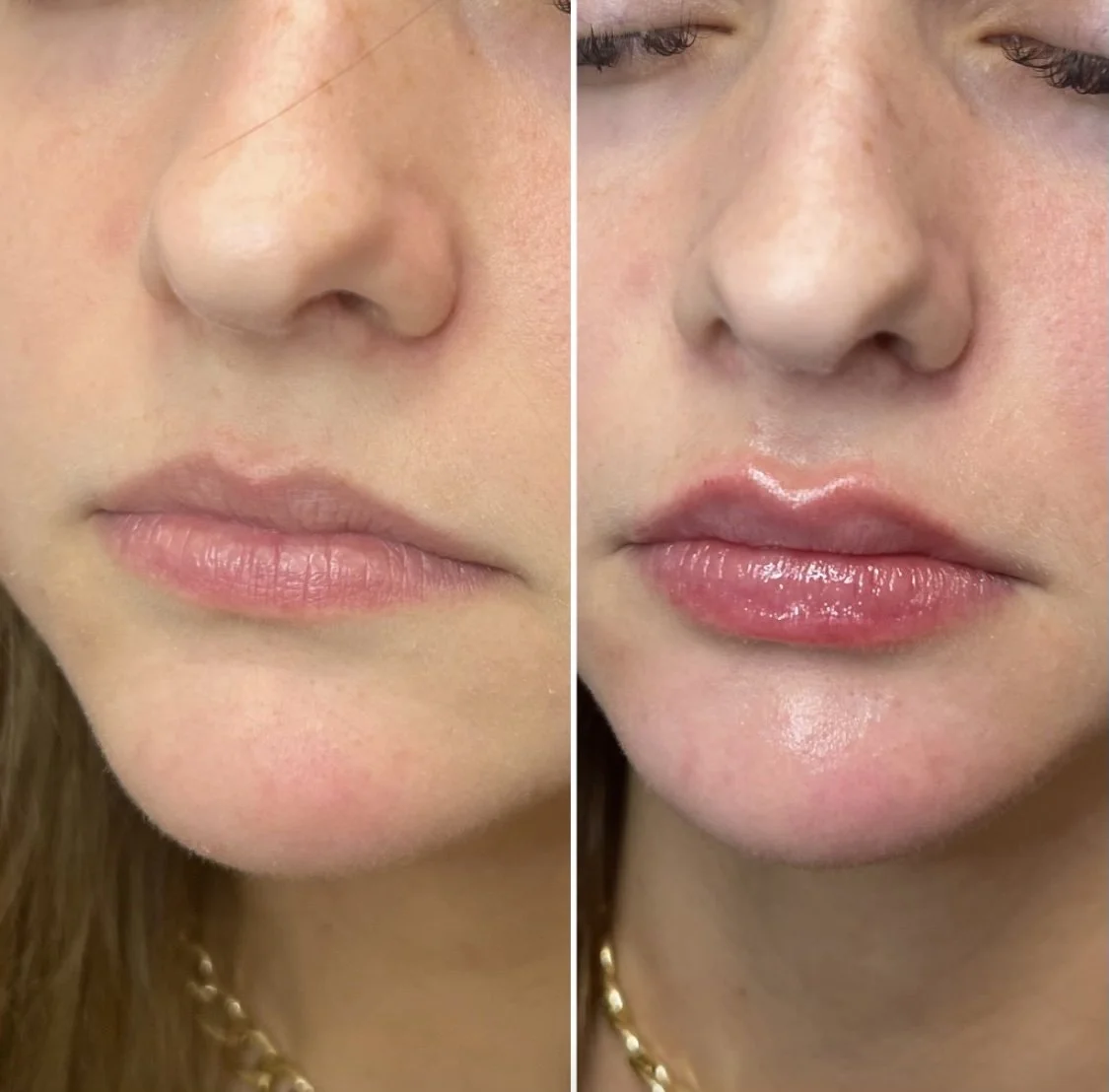 Lip filler before and after procedure.