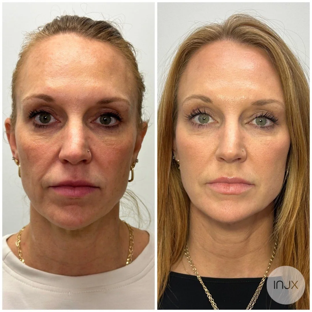 before-after-sculptra-treatment.jpg