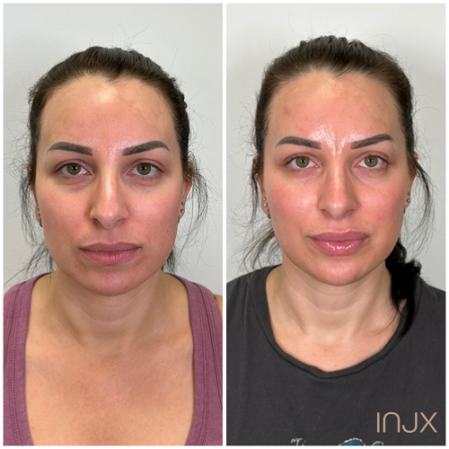  Facial balancing with dermal filler- chin filler, cheek filler, and lip filler  