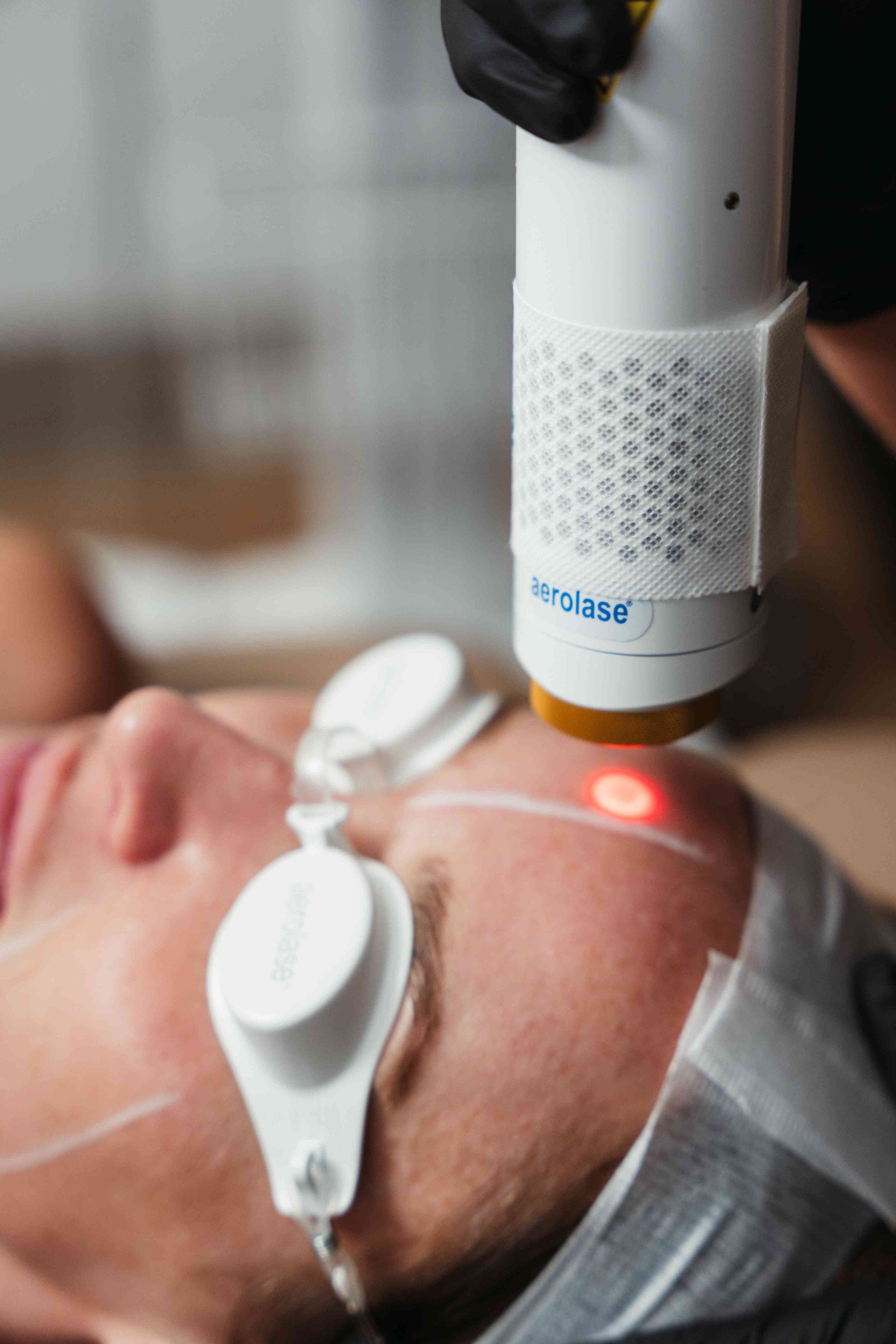 Aerolase Neo skin rejuvenation laser treatment being used on a patient's forehead.