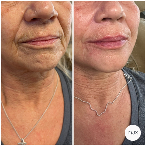  Dermal filler for treatment of lip lines AKA "smoker lines"    