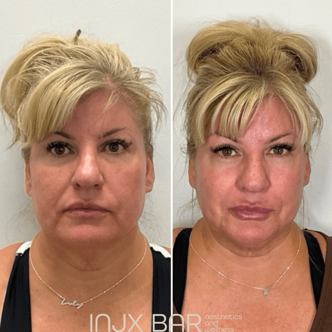 Face and neck Morpheus8 for skin tightening and facial sculpting. Areas of focus: neck and jawline 