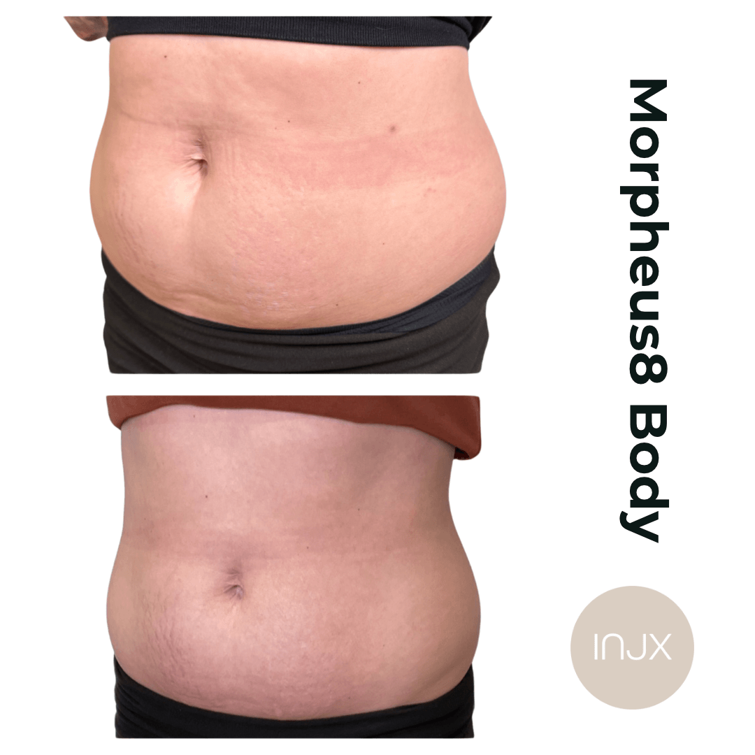  Morpheus8 body sculpting and skin tightening for the abdomen 