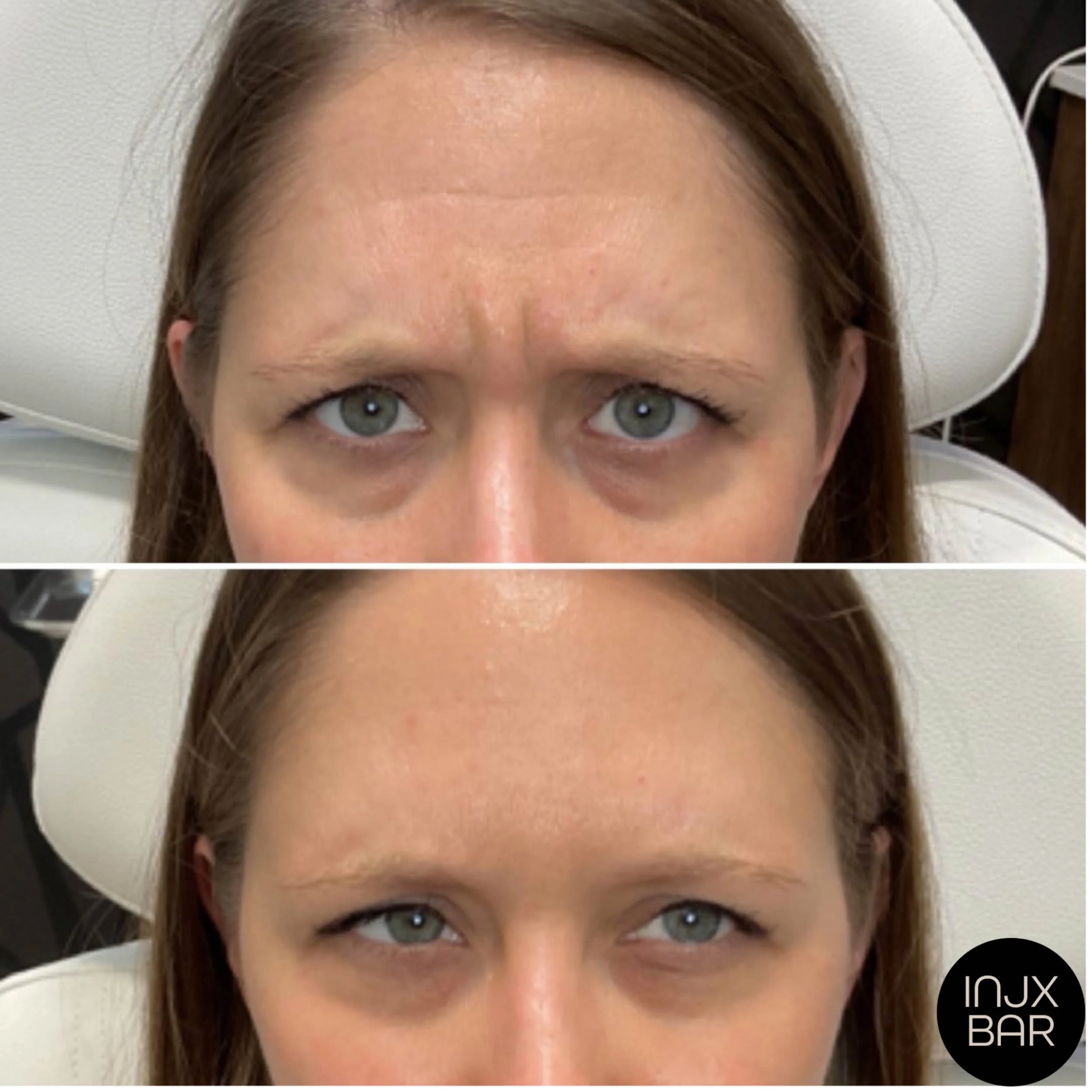 Botox-treatment-for-frown-lines.jpg