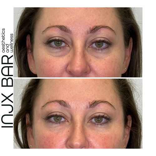  Before and After Under Eye Filler 