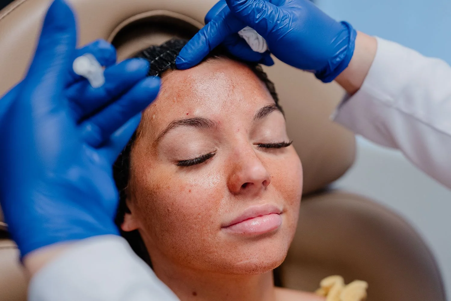Chemical Peel treatment for face and neck in Peoria, AZ.