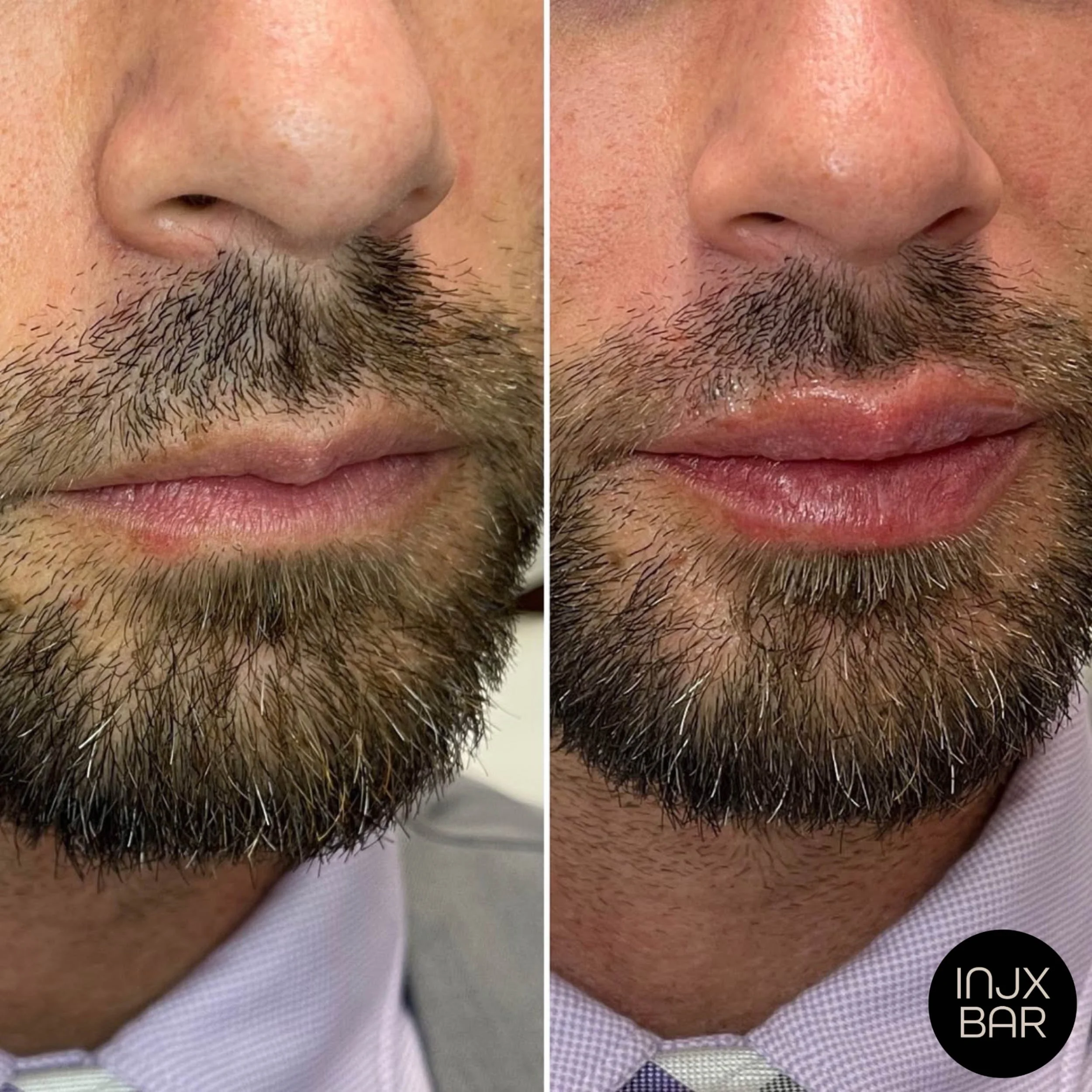 injx-bar-before-lip-filler-treatment.jpg