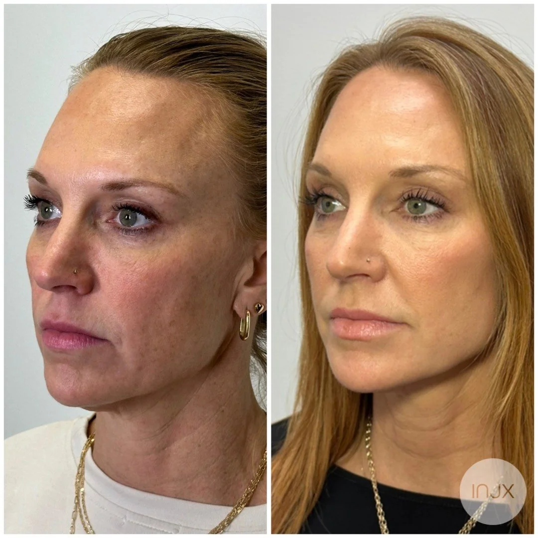 before-after-sculptra-treatment-peoria-az.jpg