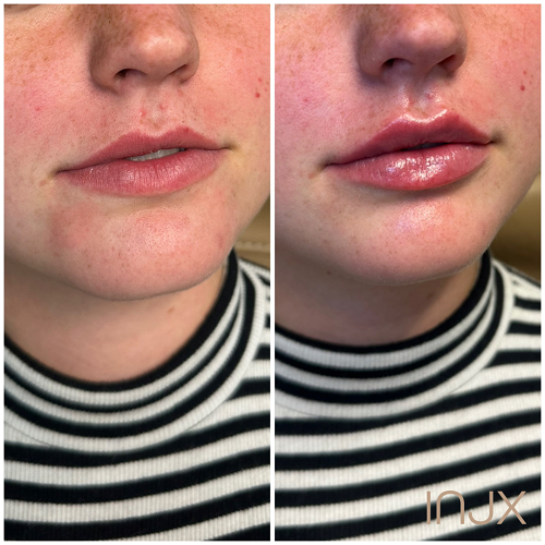  Lip filler before and after 