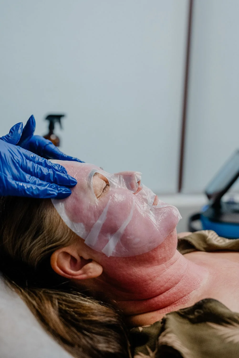Morpheus 8 treatment for face in Peoria, Az.