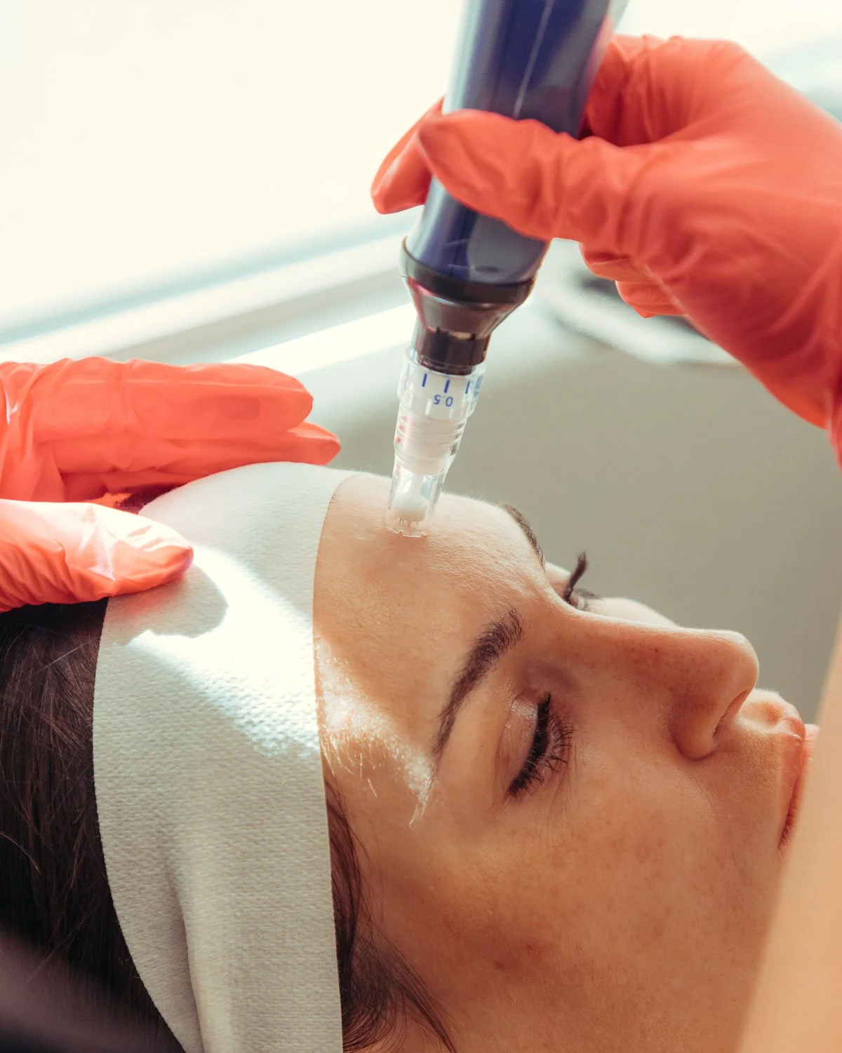 Microneedling in Peoria, AZ.