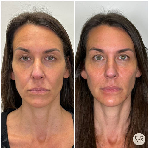  facial balancing with dermal filler 