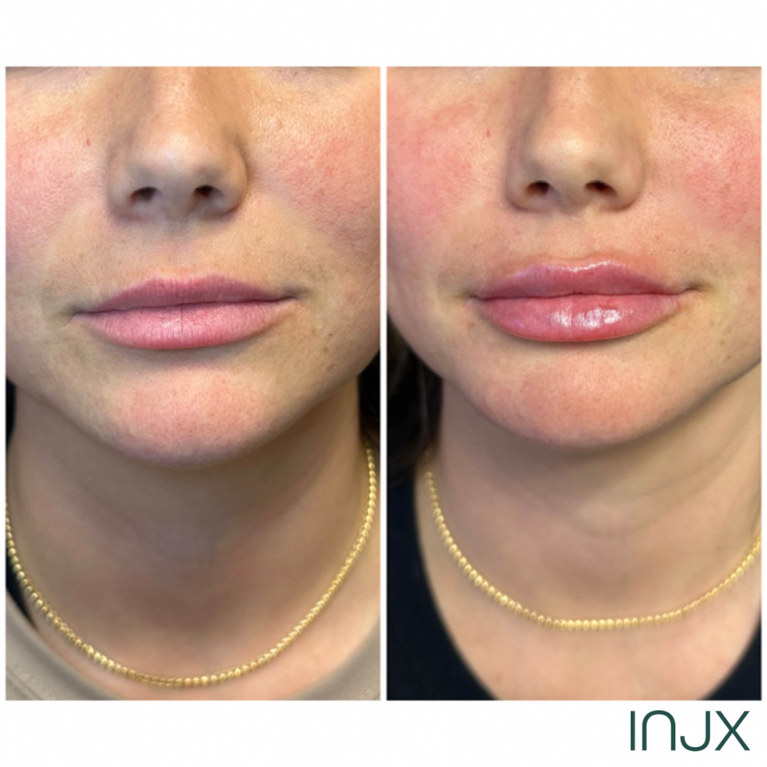 injx-bar-lip-filler-treatment.jpg
