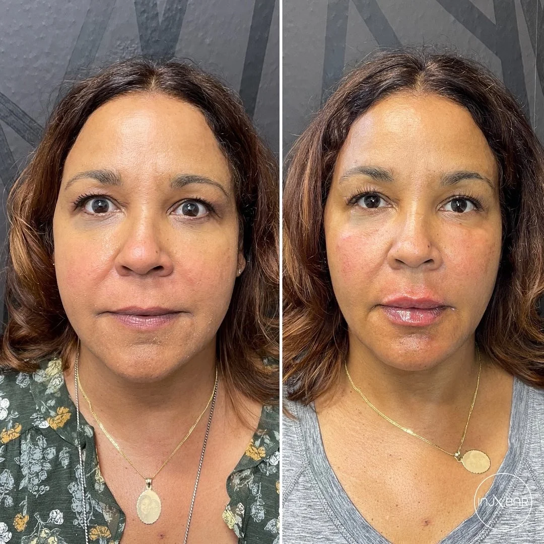  facial balancing with dermal filler 