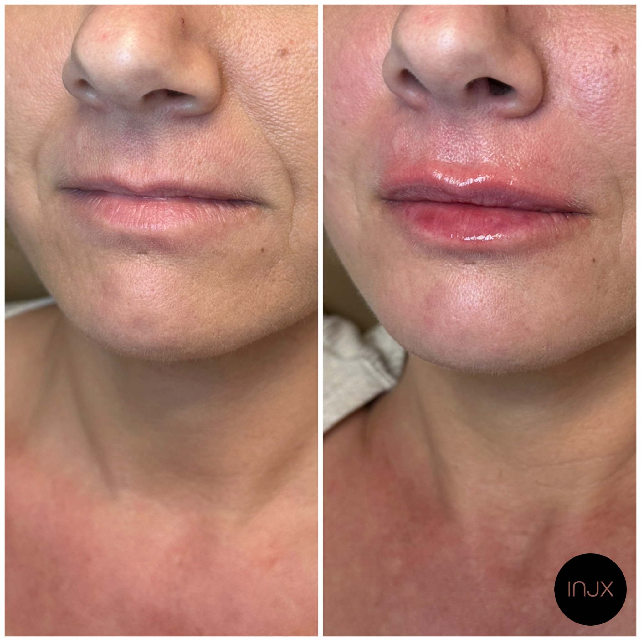  Lip filler before and after 