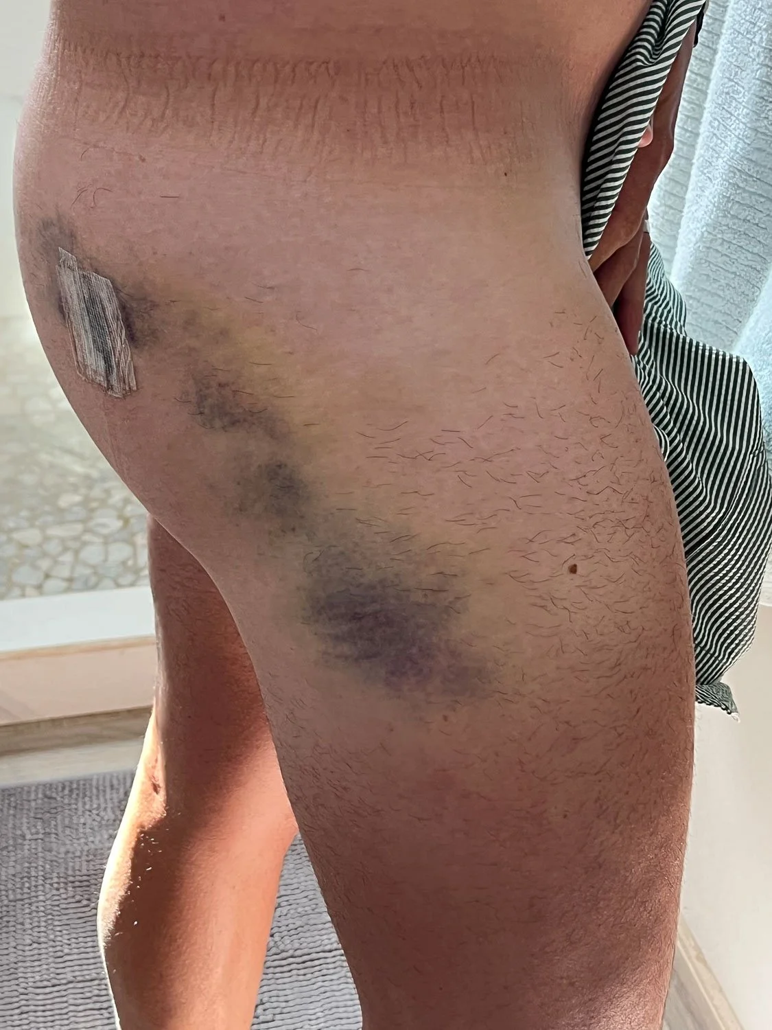 Hormone replacement therapy pellet extrusion, bruising can happen.