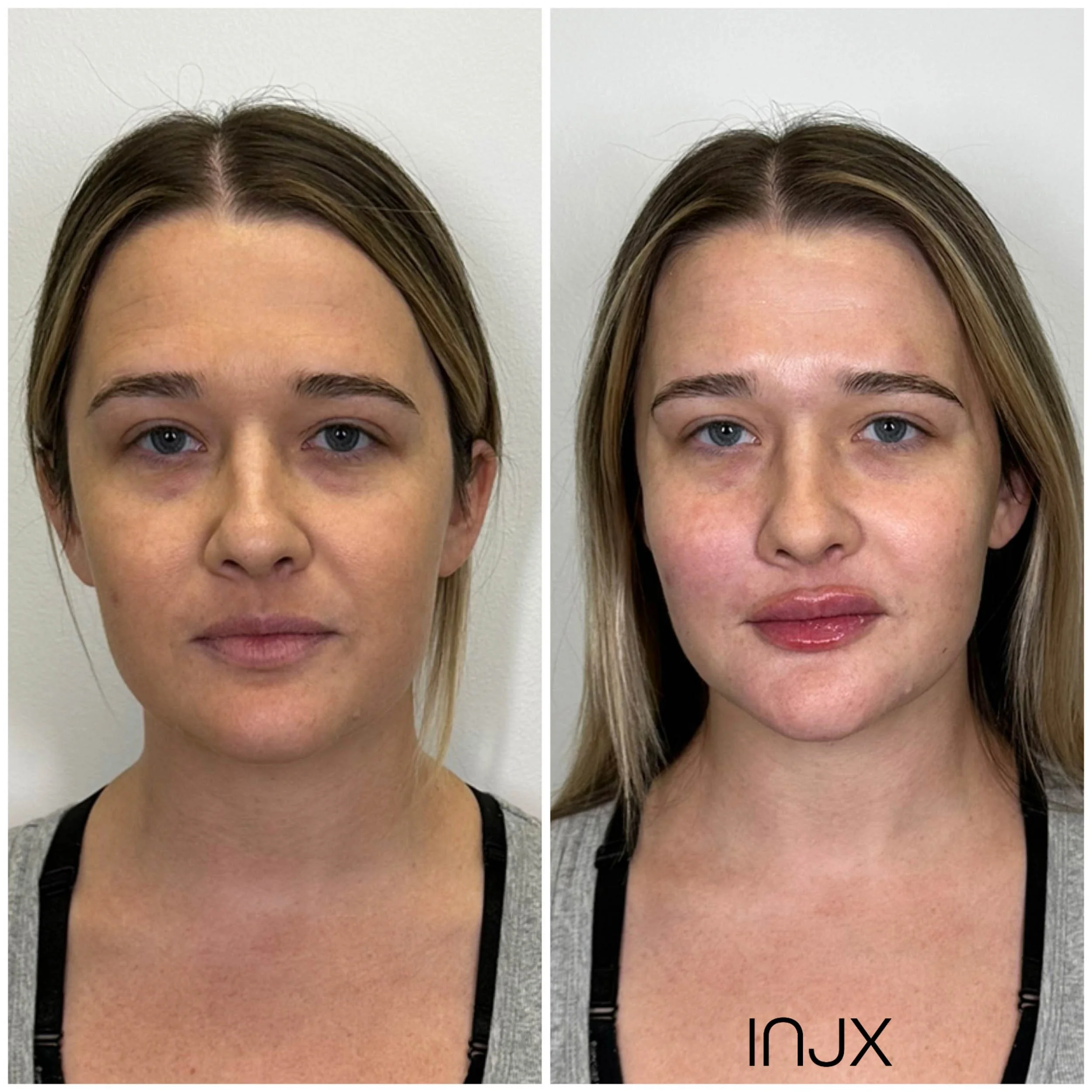 injx-bar-face-balancing-before-after.jpg