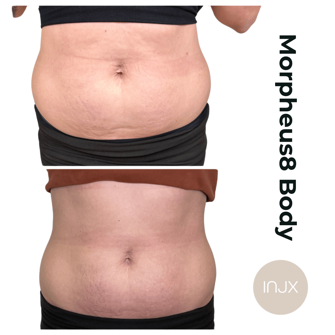  Morpheus8 body sculpting and skin tightening for the abdomen 