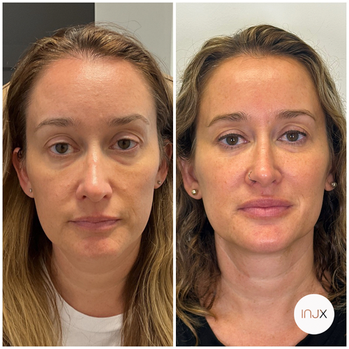  facial balancing with dermal filler 
