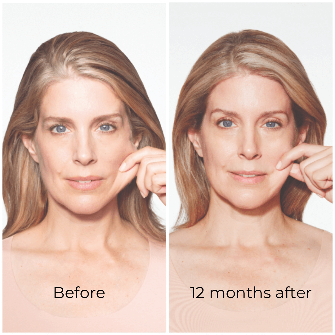 sculptra-treatment.png