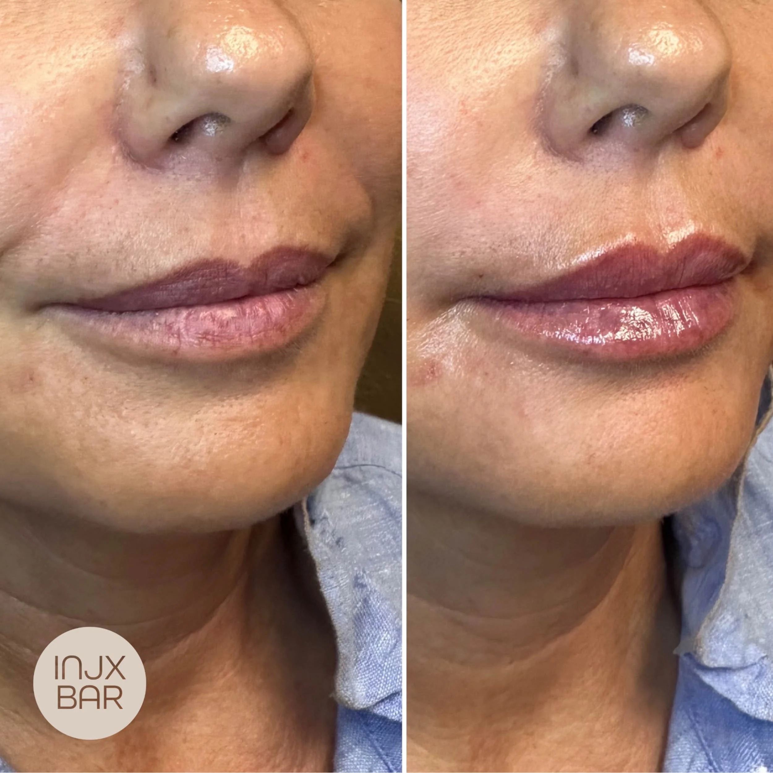 injx-bar-lip-filler-before-after.jpg