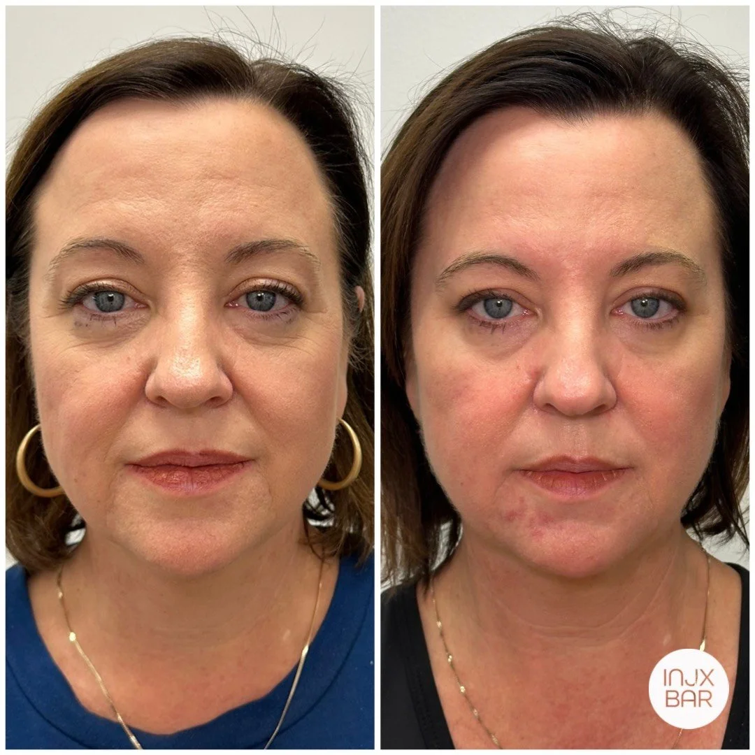 before-after-sculptra-injections.jpg