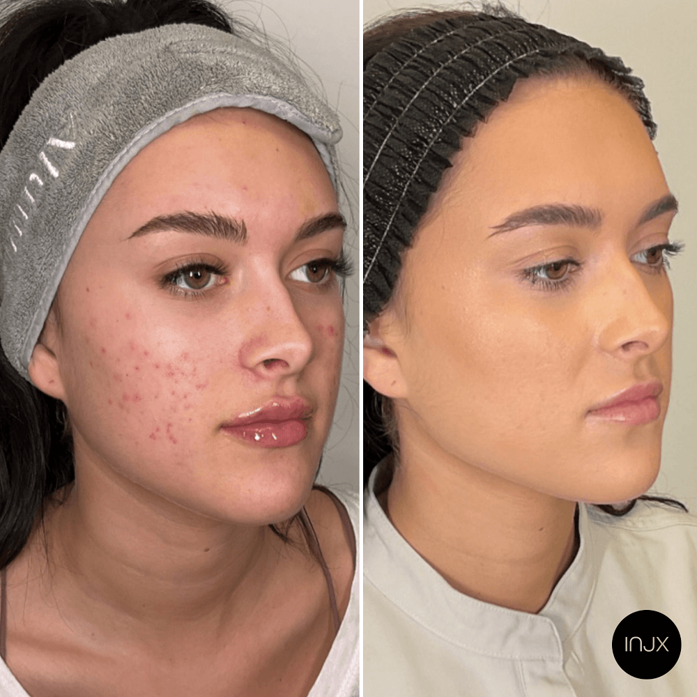 Morpheus8 for active acne and acne scarring 
