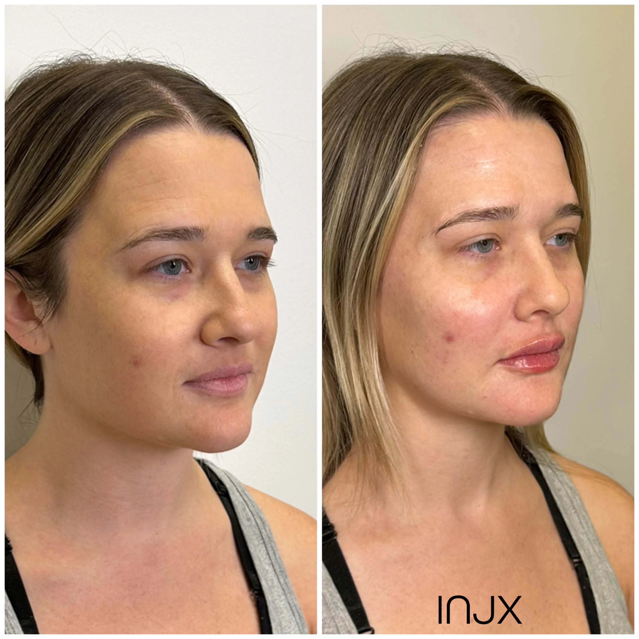 injx-bar-before-after-lip-filler.jpg