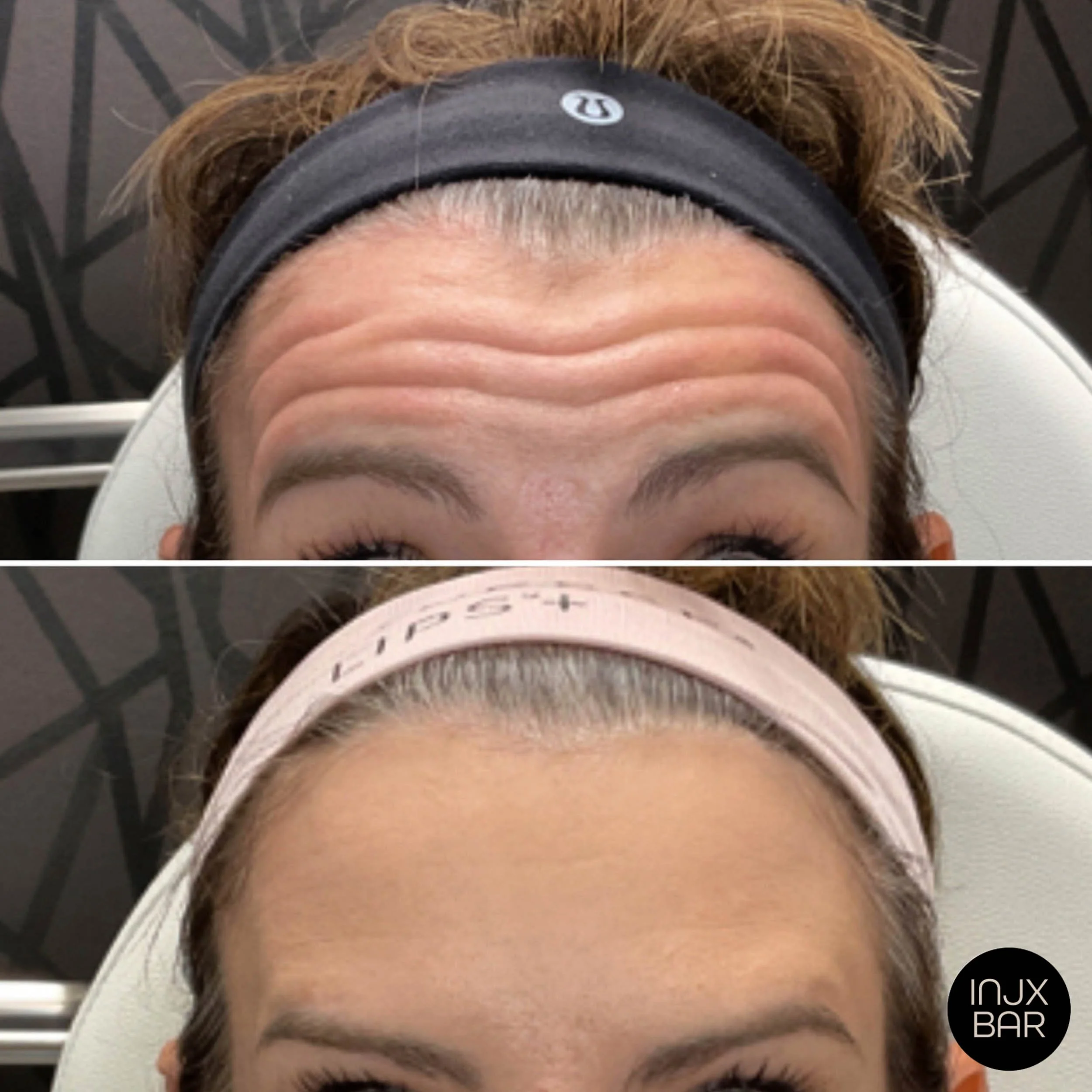 injx-bar-before-after-botox-treatment-forehead-lines.jpg