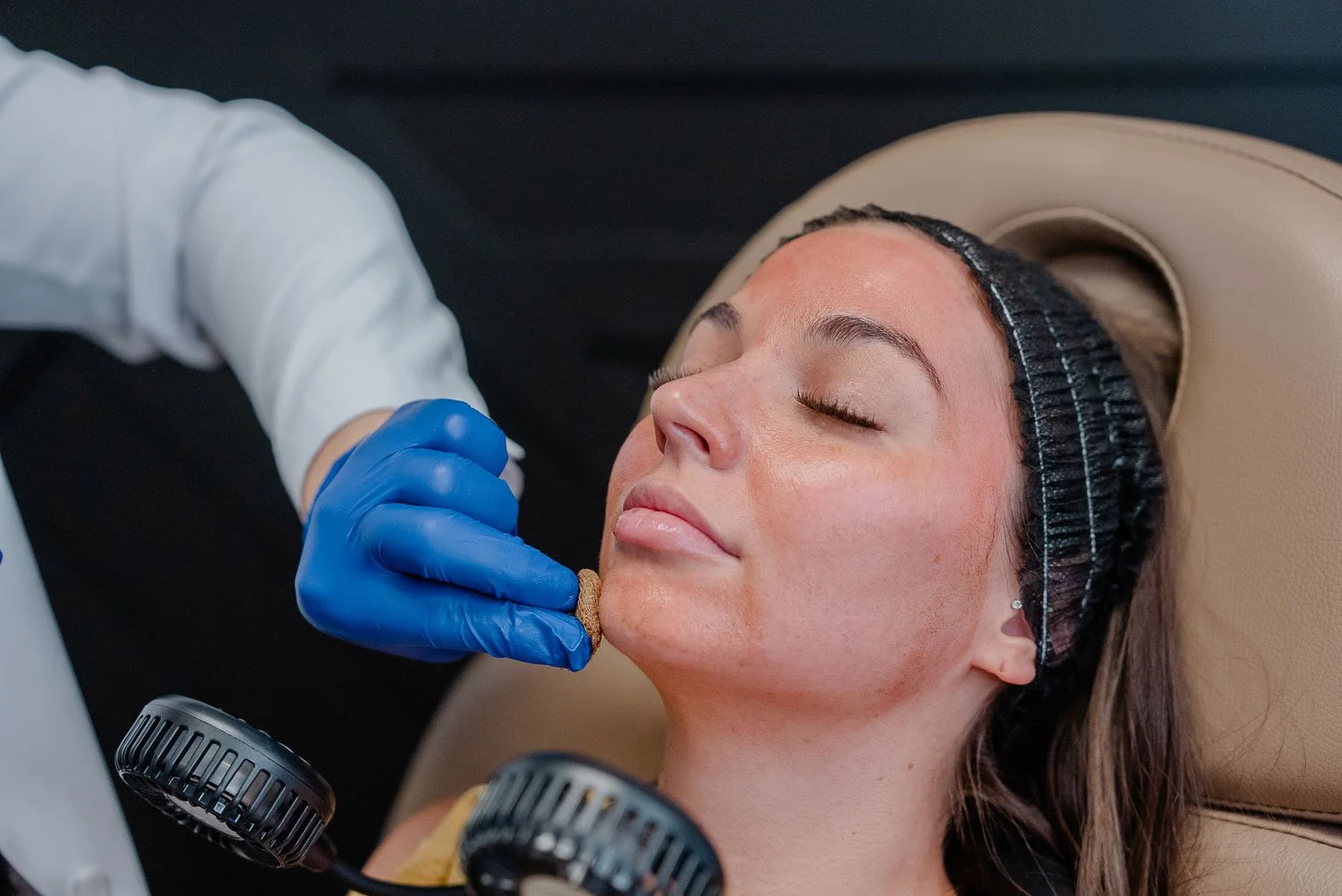 Chemical peel near Peoria, AZ.