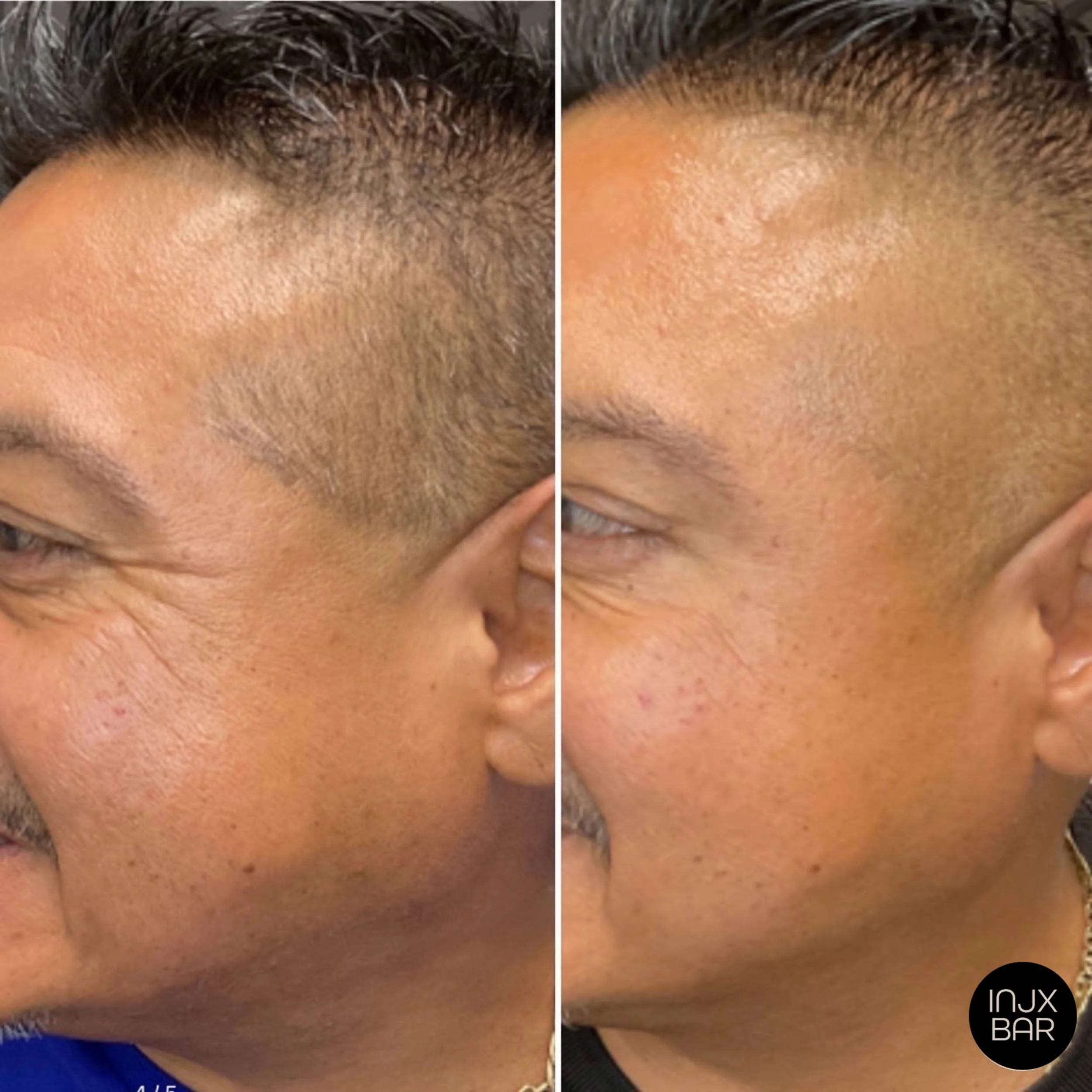 Before and 2 weeks after Neuromodulator treatment for crow’s feet