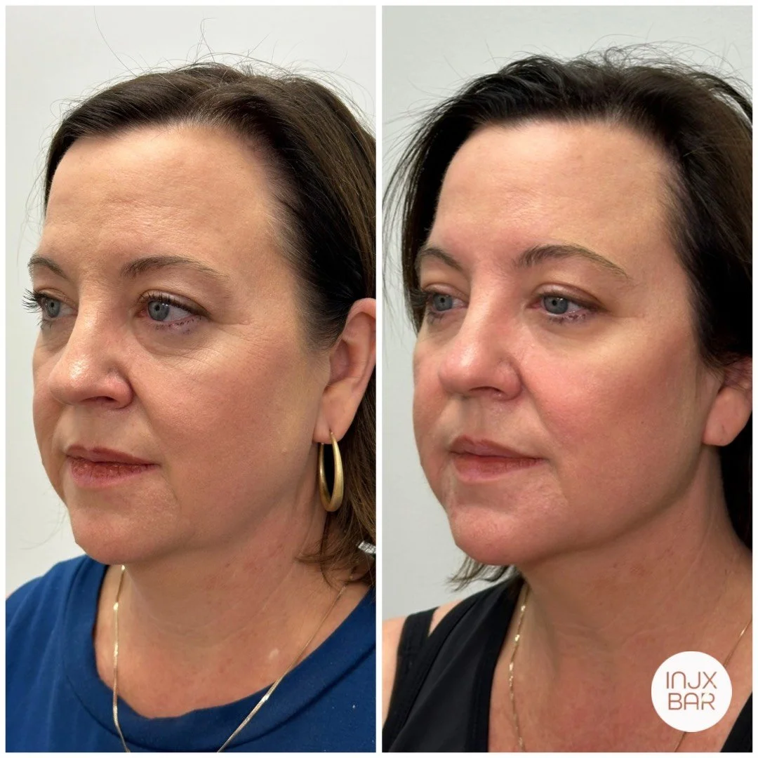 before-after-sculptra-filler.jpg