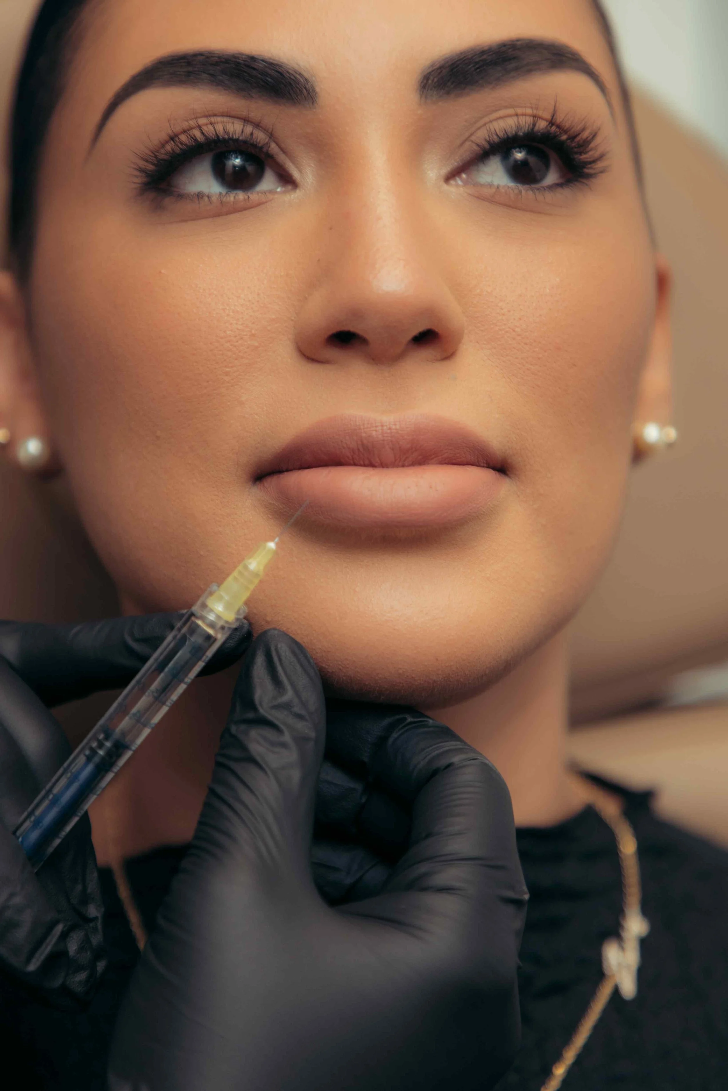 Close-up of a lip filler injection in progress, the starting point for a dramatic lip fillers before and after transformation.