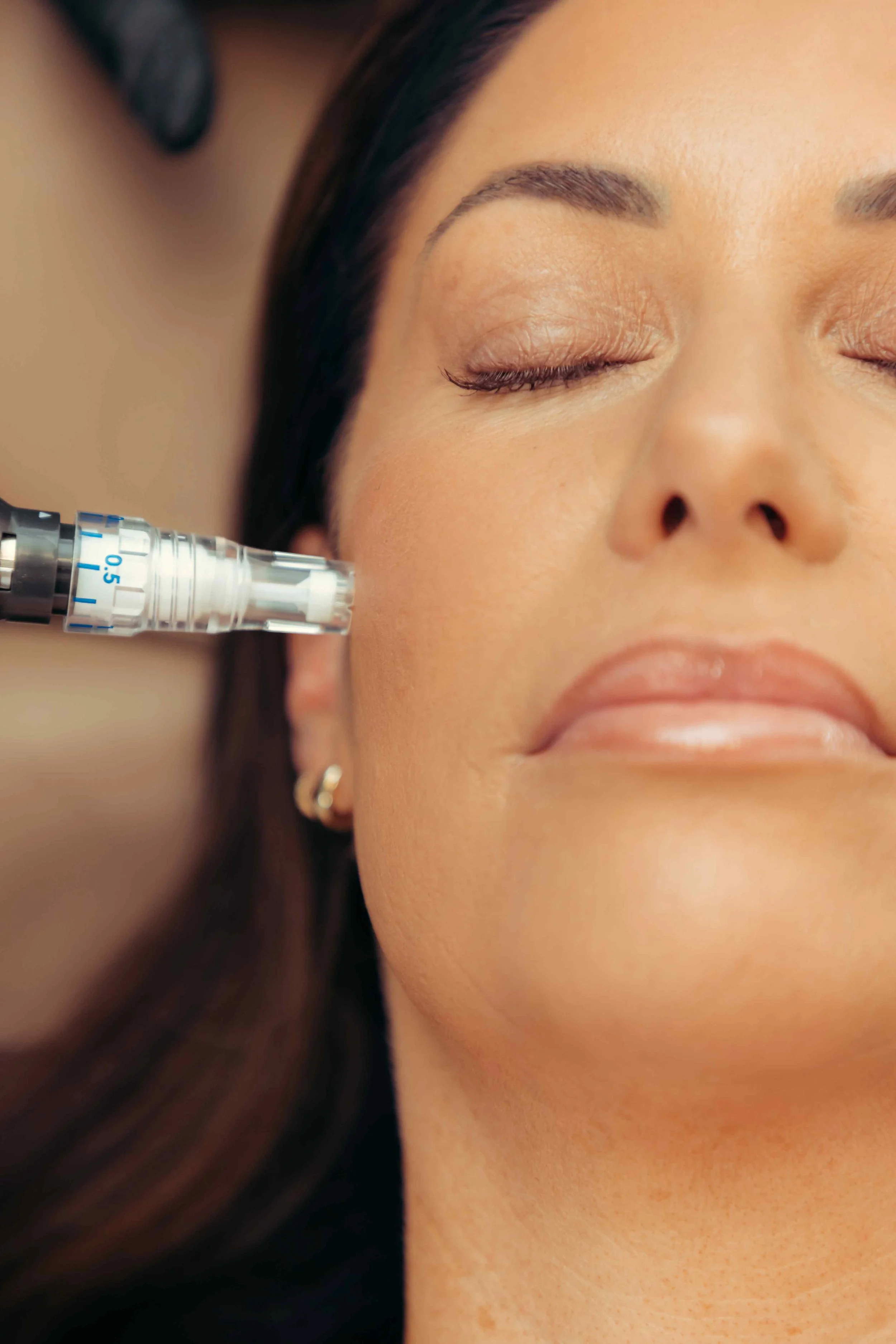 Skinpen microneedling treatments in Peoria, AZ.