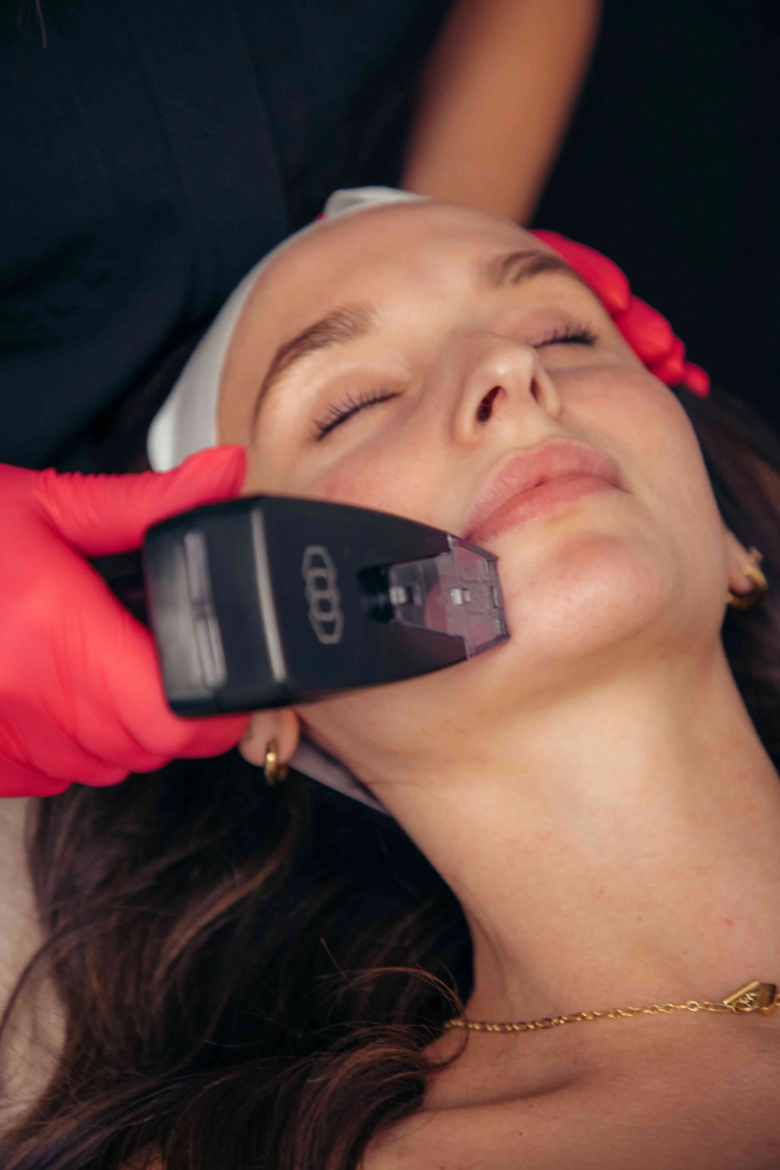 Morpheus 8 treatment for face in Peoria, Az.