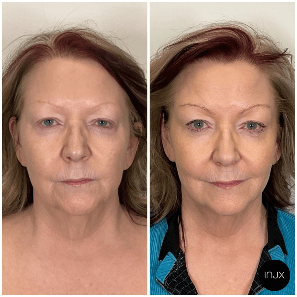  Full face and Neck Morpheus8 for skin tightening. Areas of focus: lip lines, neck and eye lids 