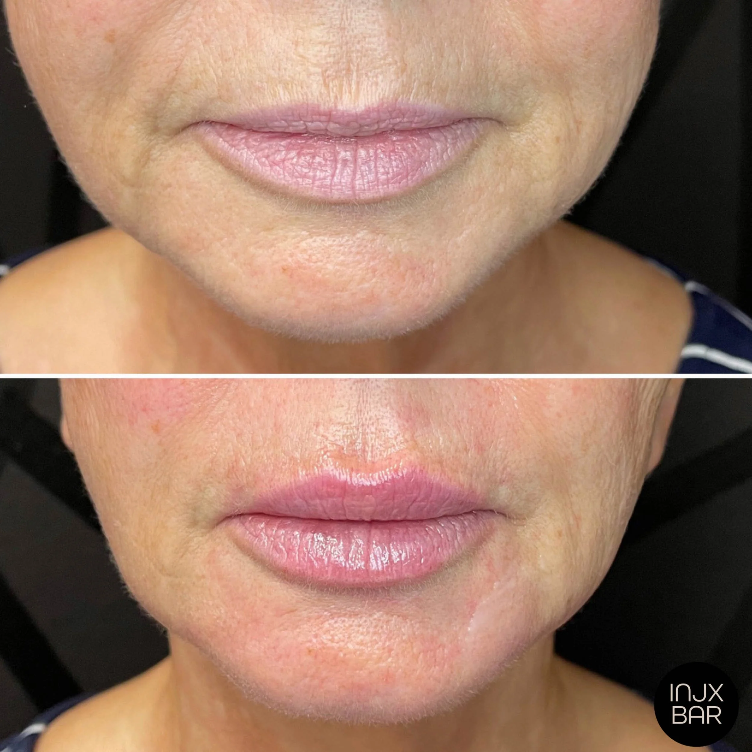 injx-bar-before-after-lip-filler-treatment.jpg