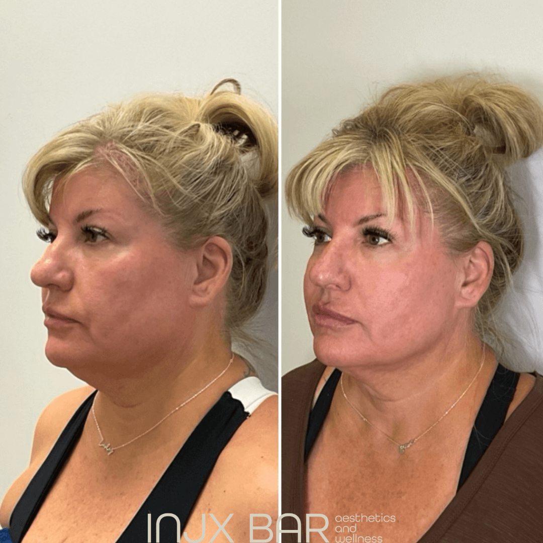  Face and neck Morpheus8 for skin tightening and facial sculpting. Areas of focus: neck and jawline 