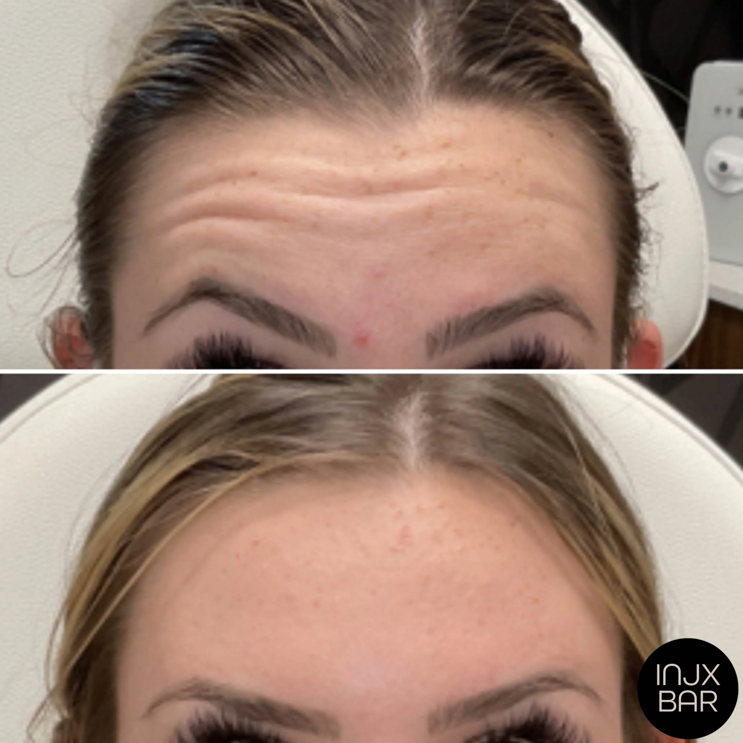 nueromodulator-treatment-forhead-lines.jpg